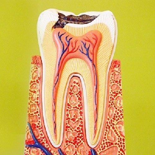 【根管治疗后磨牙】后牙 磨牙 根管治疗 3D热牙胶