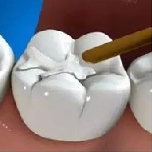 【补牙3M树脂】3M树脂补牙