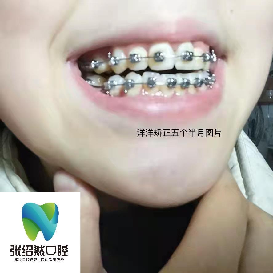 【牙齿矫正MBT矫正（普通）】直丝引矫治儿童