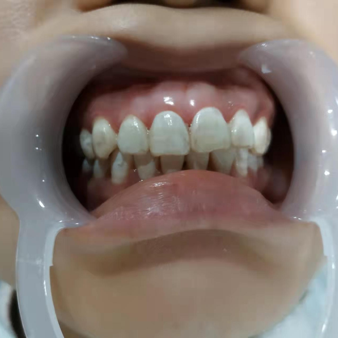 【牙齿美白3D锆齿美白(二代）】美国皓齿克立白