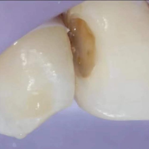 【补牙树脂美学修复】光固化树脂补牙