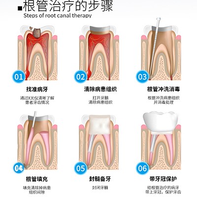 【根管治疗前牙】【显微根管】前牙根管治疗