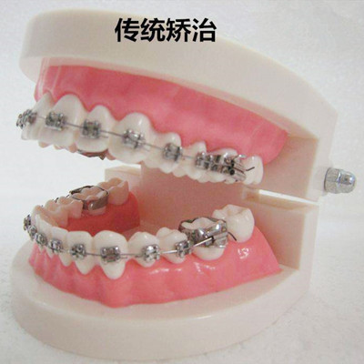 成年人牙齿矫正会反弹吗？年龄大了还有必要做牙齿矫正吗