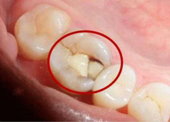 如果发现自己有牙隐裂而且不去治疗,这种情况可以维持几年?