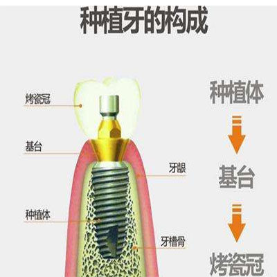 种植牙能用多久？大连做种植牙好的医院有哪些？