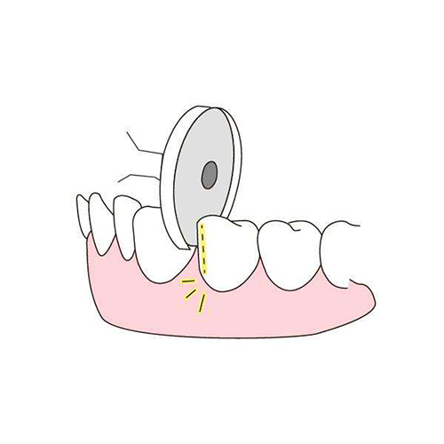 正畸片切对牙齿有影响吗?济南牙齿矫正技术实力强的医院
