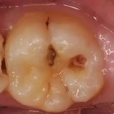 牙齿上的小黑点要怎么处理，看宁波徐茂口腔怎么治疗