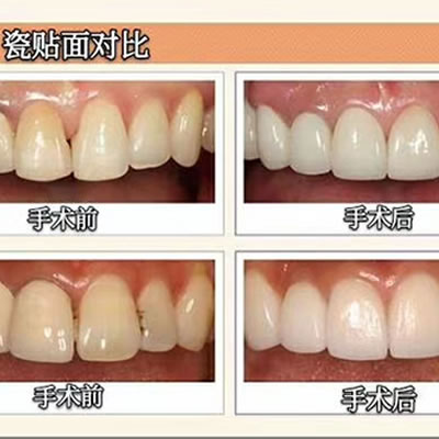 靠谱牙医告诉您，这5类人不能做牙齿整形不然后悔一辈子