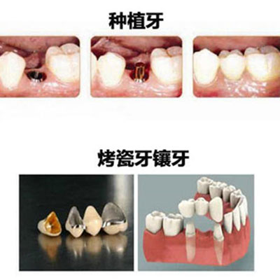 60岁种牙好还是镶牙好?种牙和镶牙哪个更安全?有啥区别?