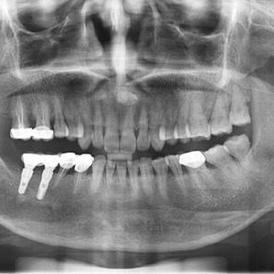 种植牙周期需要多长时间 具体种植牙流程是什么 需要去几次