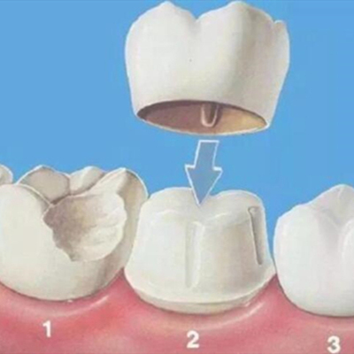 做过根管治疗后的牙齿还能用几年？