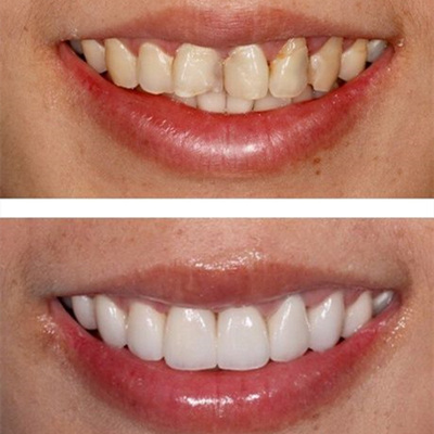 瓷贴面牙齿多少钱一颗 有哪几种材料比较好 一般能维持多久