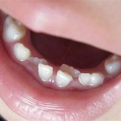 儿童矫正牙齿什么年龄合适？这几个黄金时期错过就真错过