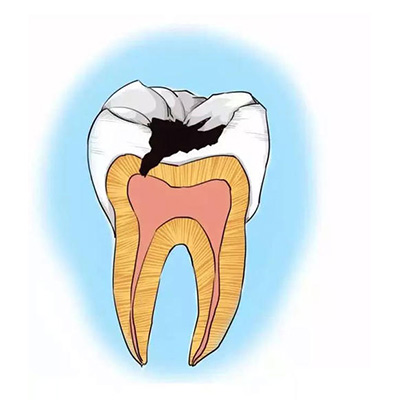 补牙为什么磨牙洞？补牙会不会越补越烂？