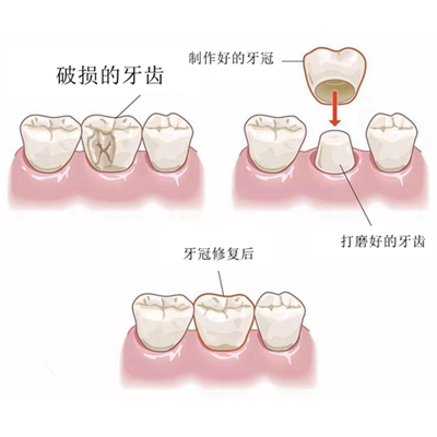 烤瓷牙套里的牙会烂吗？为什么我做完烤瓷牙会发黑发臭？