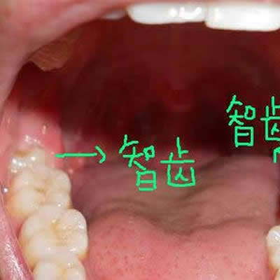 温州拔智齿多少钱一颗，哪些口腔门诊拔牙便宜？