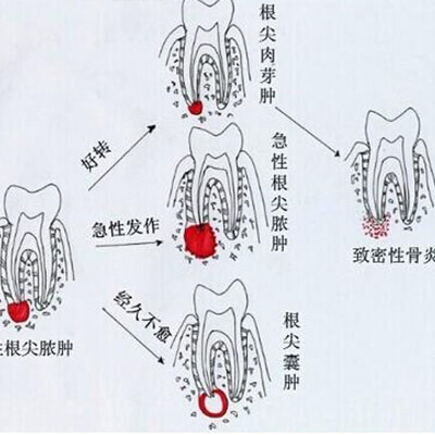 牙疼是什么原因引起的?治疗方式都有哪些?看文章了解!