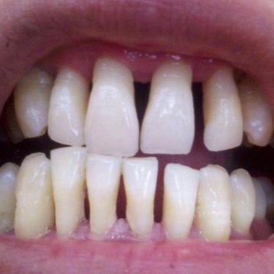 树脂补门牙缝隙后悔了怎么办？为什么不建议树脂补缝隙？