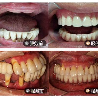 深圳德道口腔怎么样？种牙好的医生和种牙价格分享一下。