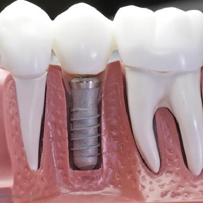 拔牙后镶牙好还是种植牙好?镶牙和种牙的区别是什么？