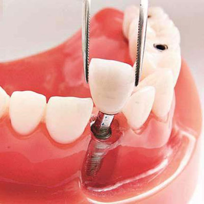 汉中哪家口腔医院能做种植牙？种植牙多少钱一颗？
