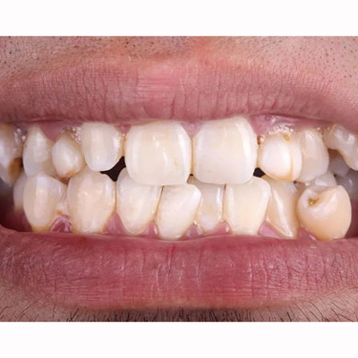 牙齿矫正多长时间能看到效果？正畸看出效果也分这5种情况