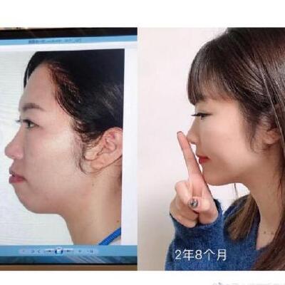做过烤瓷牙和种植牙还能不能做正畸？带牙套牙齿会掉不