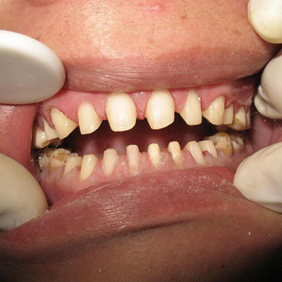 戴全瓷牙套的危害有哪些,听说全瓷牙套里的牙会烂是真的?