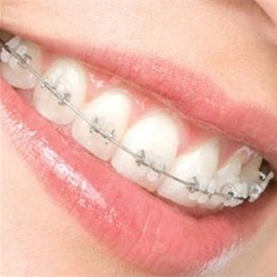 牙齿矫正有几种方式？看完才知道你适合的只有这一种！