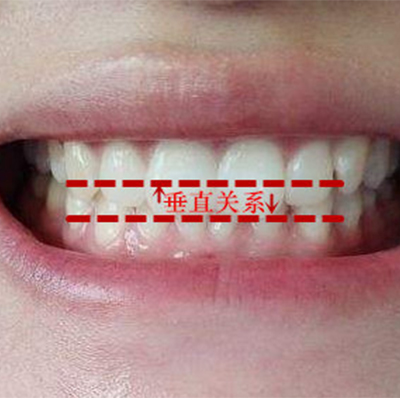 牙齿深覆合矫正费用是多少?在郑州深覆合牙齿矫正多少钱?