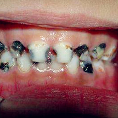 牙齿上面有黑色刷不掉怎么办?牙齿缝隙发黑是蛀牙吗?