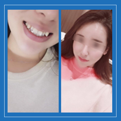 天津美奥口腔好不好？牙齿矫正结果和项目价格来揭晓！