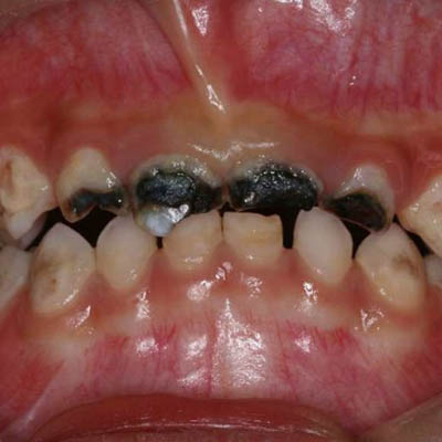 368元 口腔项目  儿童补牙 恢复时间  7天 收藏 儿童牙齿相对成人