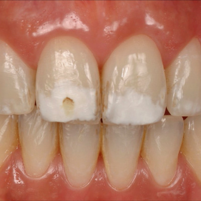 牙齿钙化