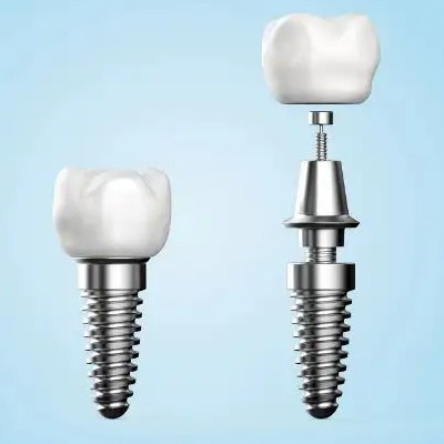 7个方面带你了解种植牙-名医汇
