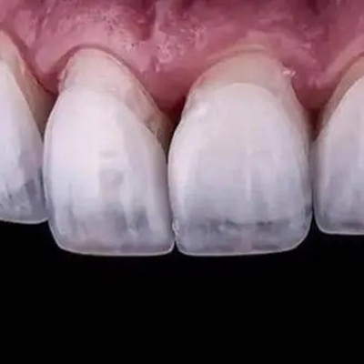 贵阳哪里可以做美牙瓷贴面治疗，这几家牙科诊所技术过硬