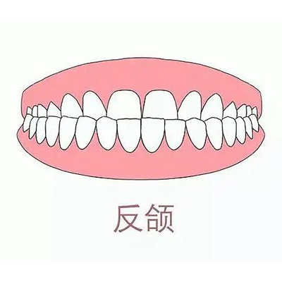 北京反颌正畸大概多少钱?反颌整牙金属/陶瓷/隐形费用公布!