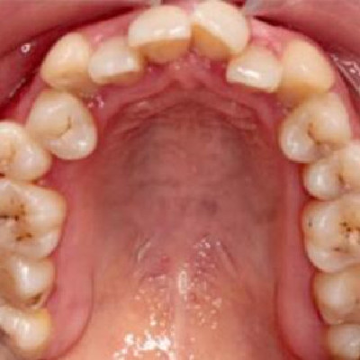 15个月告别牙列拥挤+反颌 通过牙齿矫正我变身灵气女神