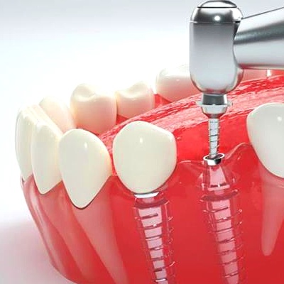 合肥哪种牙好?精选合肥种牙比较好又便宜的口腔医院明细