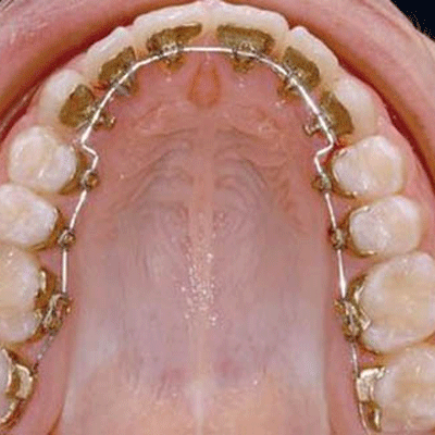 西宁牙齿矫正价目表，金属牙套7000/隐形牙套18000元！