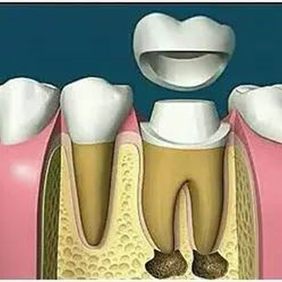 鄂尔多斯根管治疗多少钱，哪家好？便宜又好的牙科推荐！