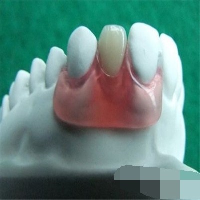 隐形义齿是什么材质做的？它的优缺点又有哪些呢？