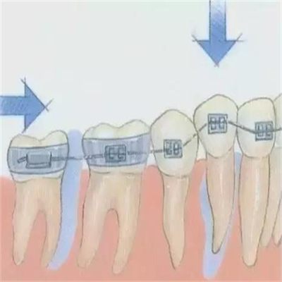 分享牙齿矫正拔牙的惨痛经历,看完你会如何选择?