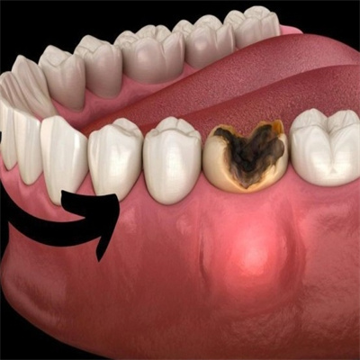 2023补一颗龋齿需要多少钱?龋齿损坏程度/补牙材料都影响!