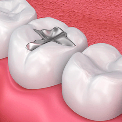 牙齿修复收费价目表大公开，来看牙齿修复方法和价格