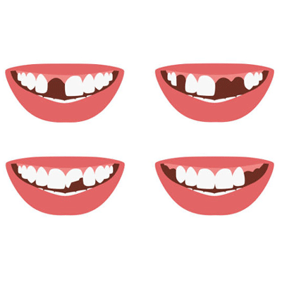 镶牙痛吗?一文带你了解完整的镶牙流程以及镶牙有几种方法
