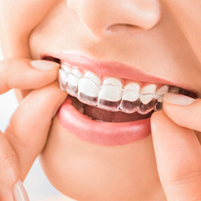 牙齿矫正价格是多少？有哪几种方式？
