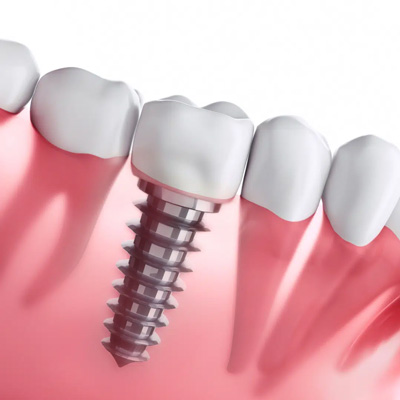 数字种植牙与传统区别有什么?为什么受到越来越多牙科推崇