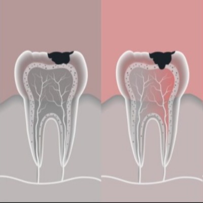 智齿有龋坏，怎么办？补牙VS拔牙，哪种方案更适合你？